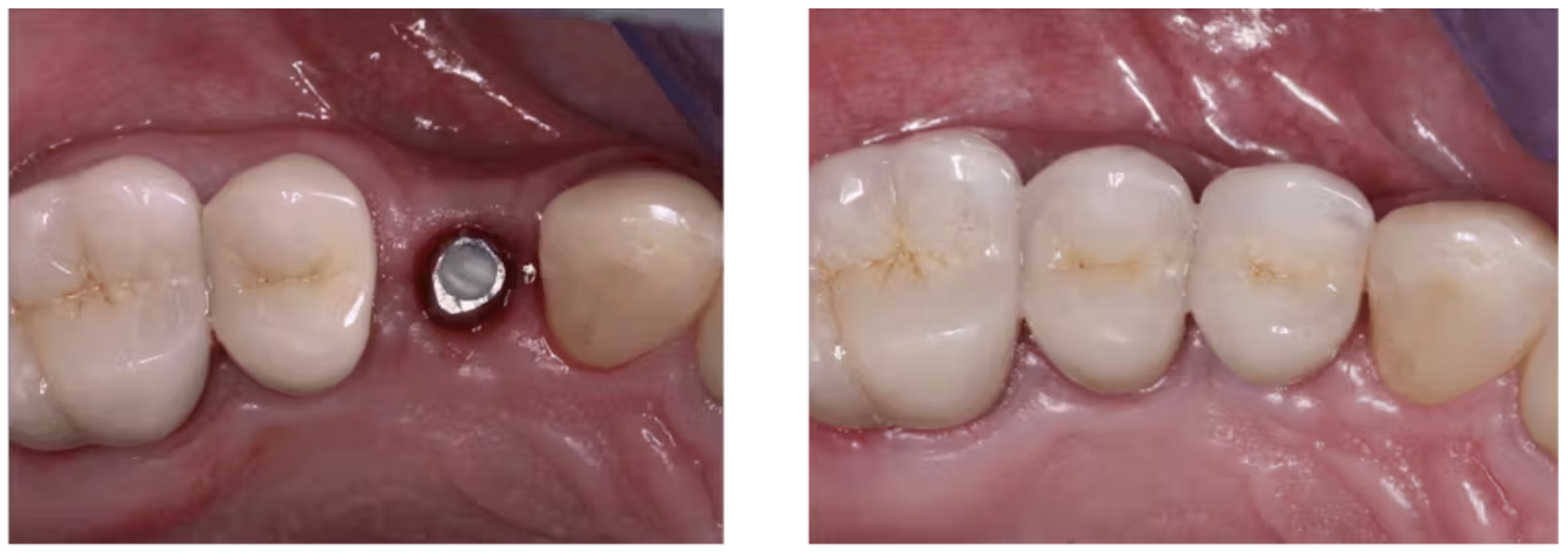 In 3D răng sứ đang phát triển mạnh: Liệu công nghệ này có phù hợp với phòng khám của bạn?